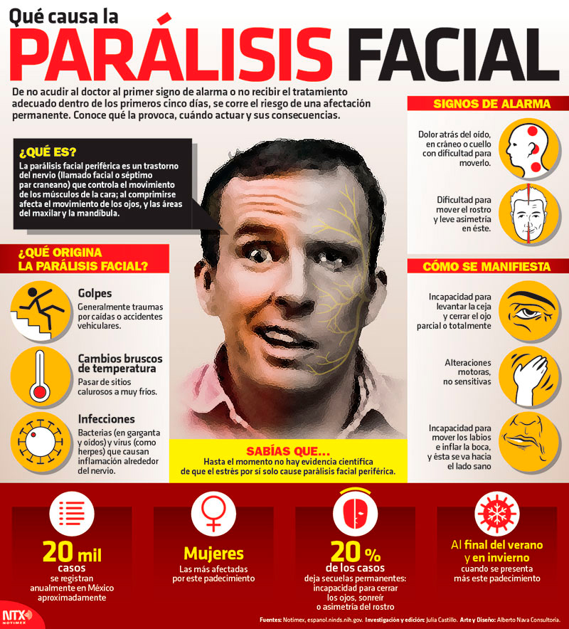 Hoy Tamaulipas Infografía Qué Causa La Parálisis Facial 9441